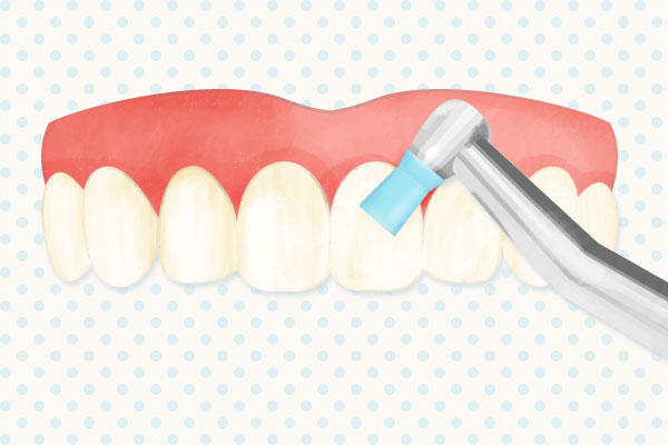 歯面の清掃（PMTC）