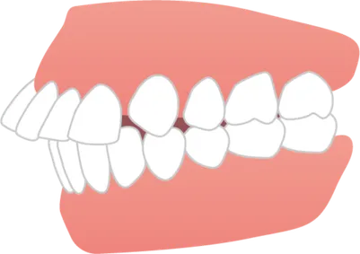 出っ歯のイラスト