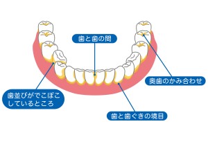 歯　むし歯