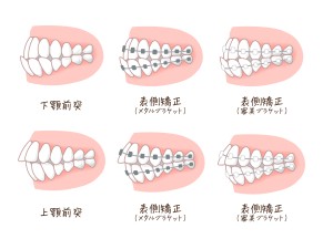 矯正治療　歯列矯正