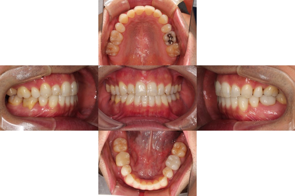case23_歯の凹凸_3年半