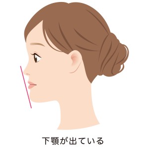 受け口　下顎前突