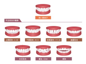 歯並び 不正咬合