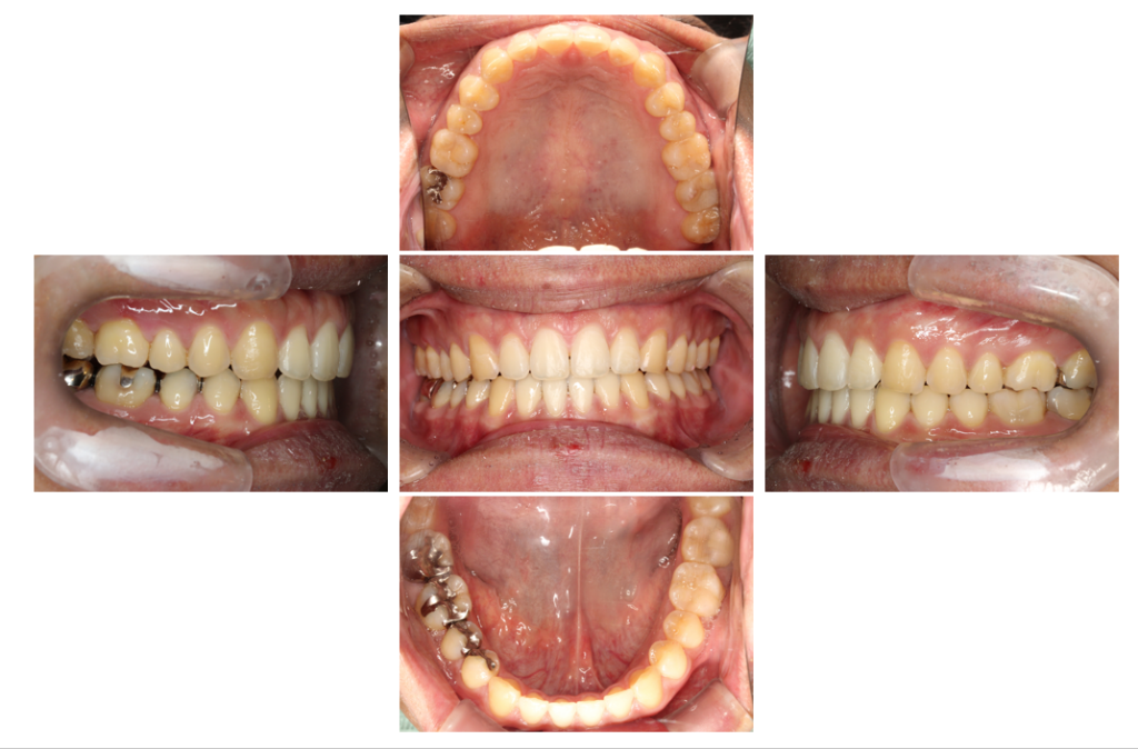 すきっ歯　マウスピース矯正