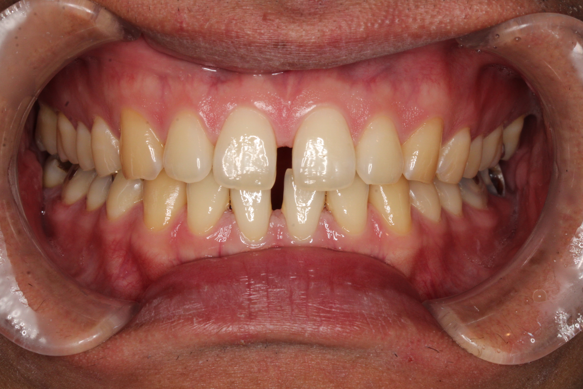 すきっ歯　マウスピース矯正