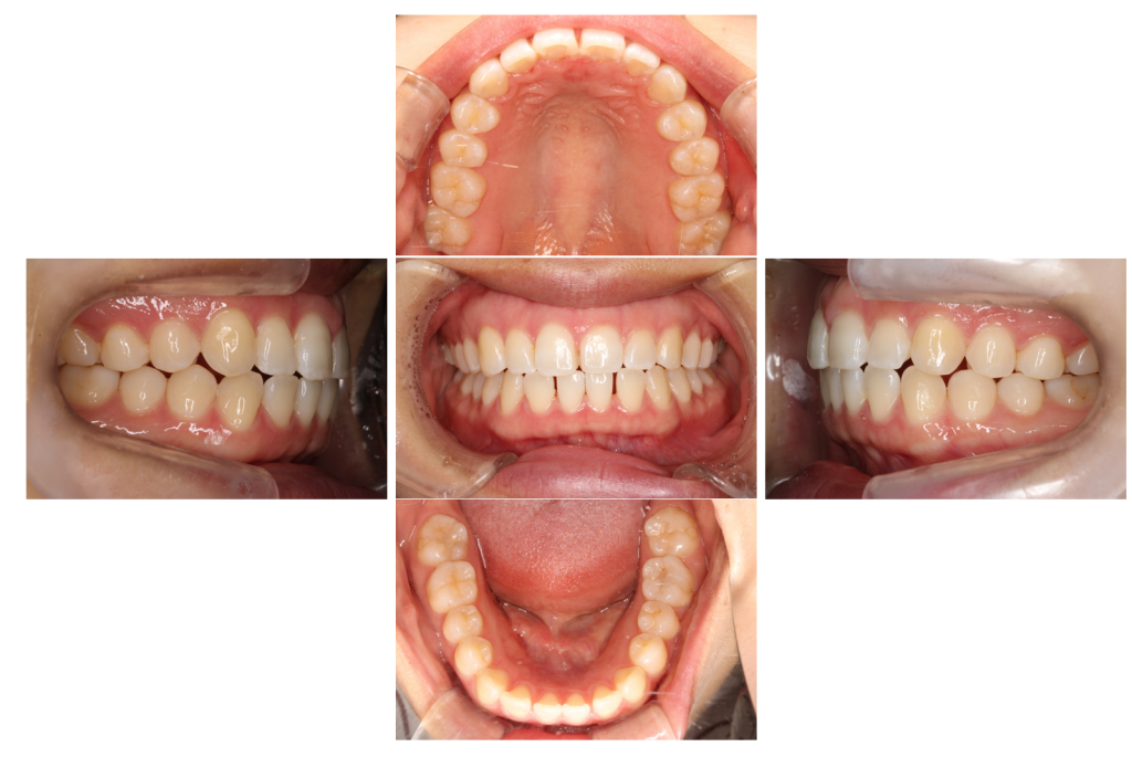 すきっ歯　部分矯正