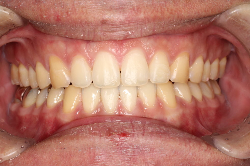 すきっ歯　マウスピース矯正