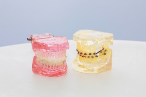 矯正　歯列矯正